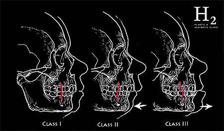 angle-classes