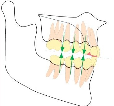 deep-bite-open-bite-3