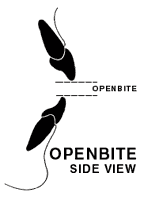 openbite