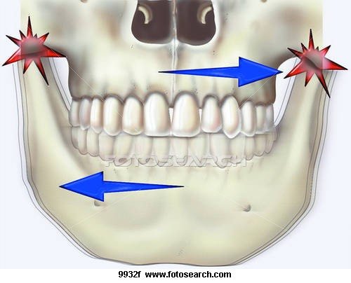 bruxism