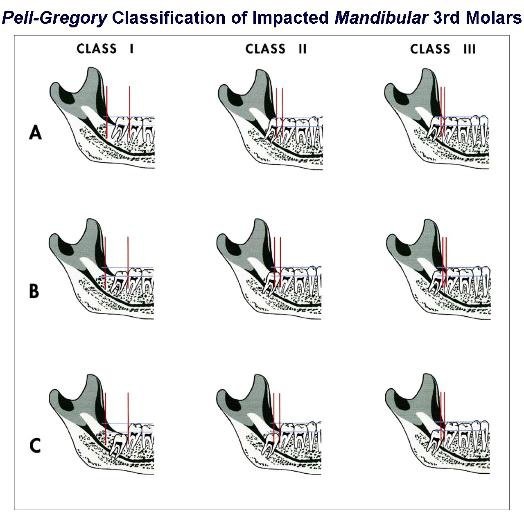 Pell-Gregory_Classification_of_Mandibular_3rd_Molars-524x515