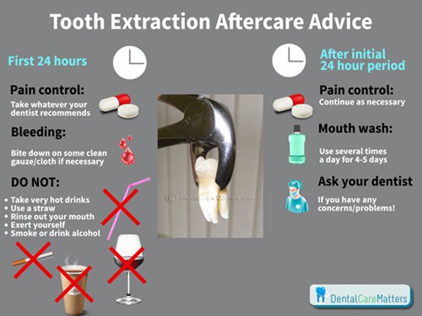 Tooth-extraction-aftercare