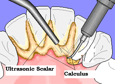 Scaling-at-Dental-clinic-in-noida-dentist-in-noida