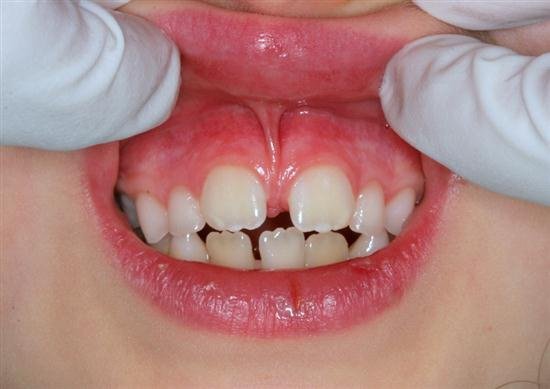 laser-frenectomy-before-s