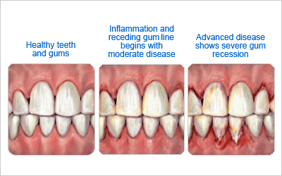 3-Pics-Gum-Disease-Compare