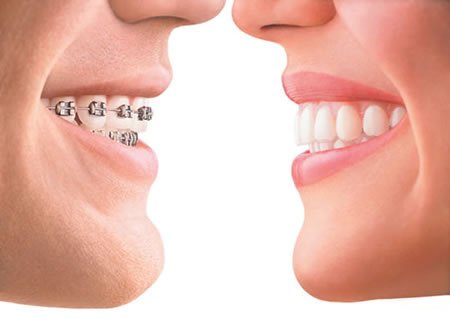 Invisalign-facetoface