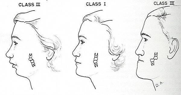 Types-of-Malocclusions