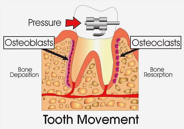 Tooth-Movement