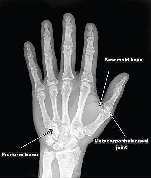 Hand-x-ray-by-OpenStax-College.jpg