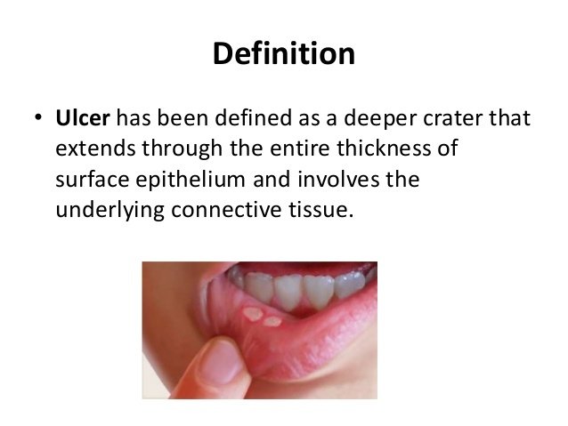 solitary-oral-ulcers-and-systemic-diseases-2-638.jpg