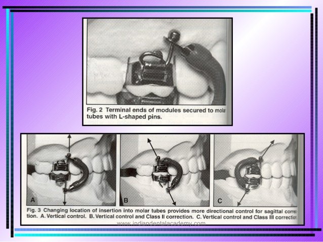 a-rapid-molar-intruder-for-noncompliance-treatment-3-638.jpg