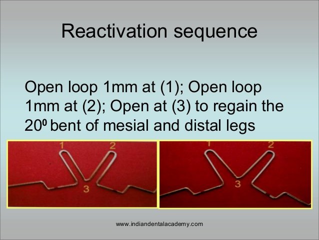 biomechanics-of-molar-distalization-appliance-certified-fixed-orthodontic-courses-by-indian-dental-academy-81-638.jpg