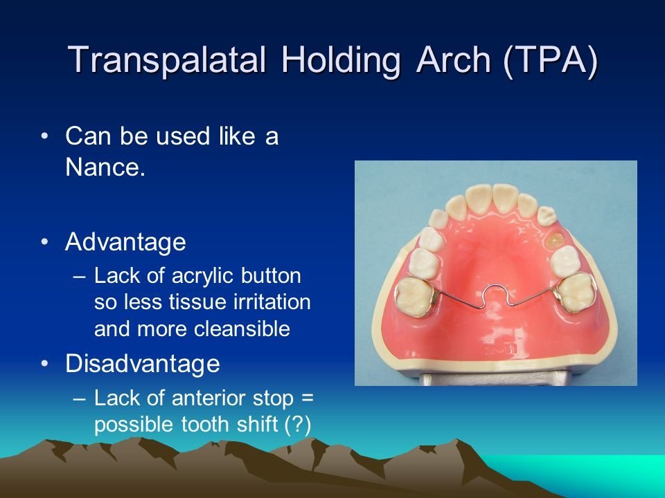 Transpalatal+Holding+Arch+(TPA).jpg