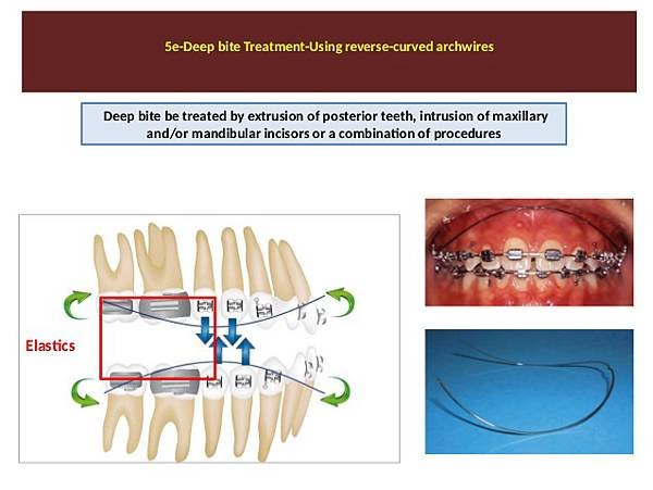 deep-bite-malocclusionsm-aboulnaser-orthodontist-bua-usa-o-sandid-orthodontist-29-638.jpg