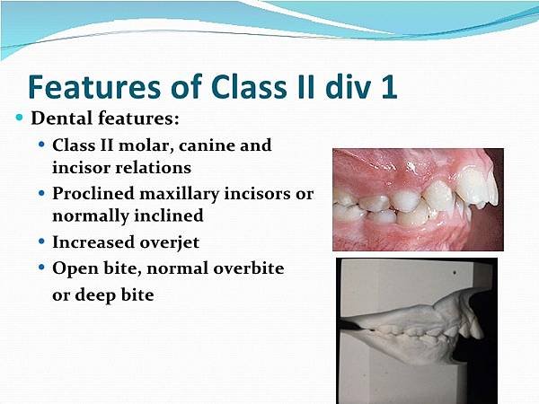 management-of-class-ii-division-1-malocclusion-8-728.jpg