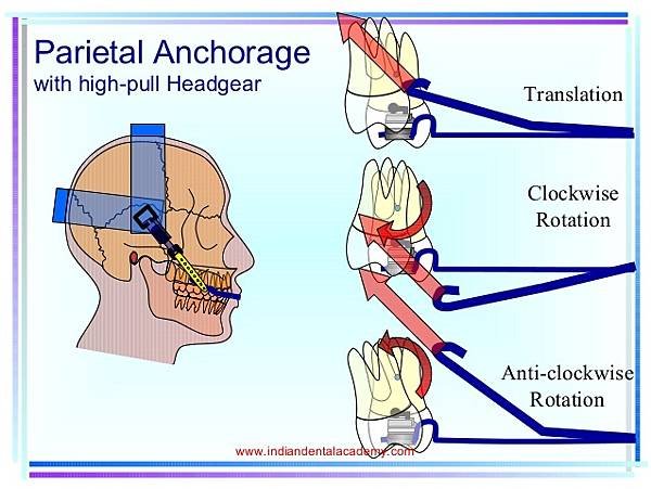 headgears-50-638.jpg