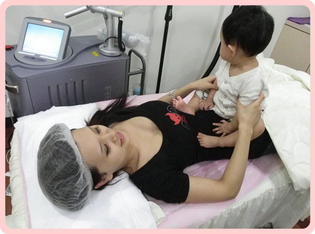 baby光雷射