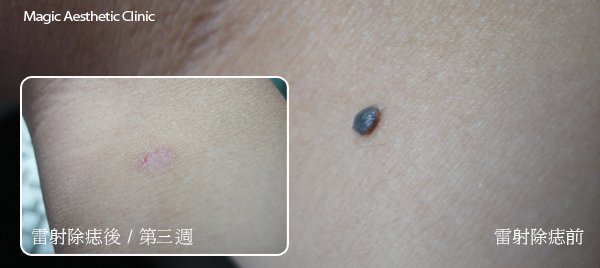 雷射除痣