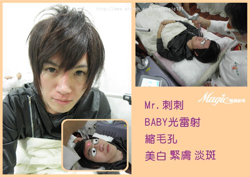 BABY光雷射