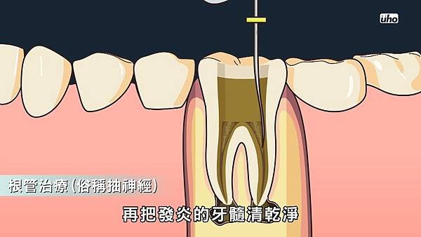 【看好你的牙】第5集-牙齒吃冷吃熱會痛預示著什麼 by魔法牙醫 潘韞珊院長.mp4_20170803_155617.193.jpg