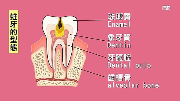 【看好你的牙】第2集-蛀牙、牙周病竟會要你命! by魔法牙醫 潘韞珊院長.mp4_20170804_132522.951.jpg