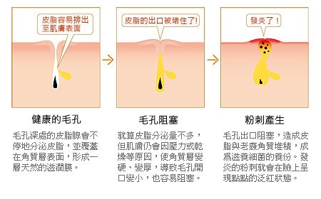 粉刺-2