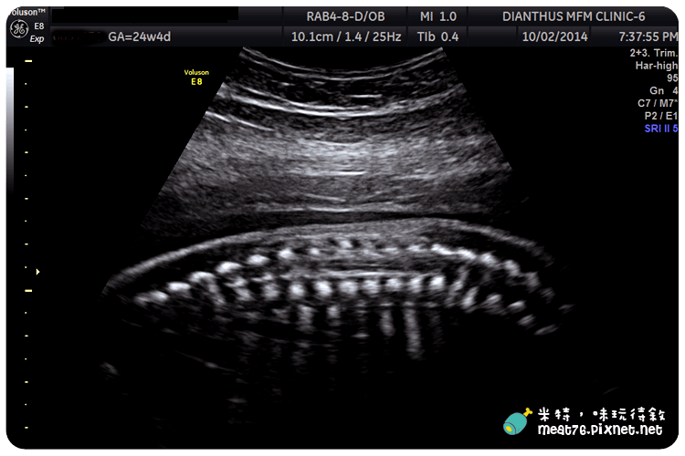 米特，味玩待敘｜部落格 © MEAT76｜台灣美食旅遊部落客｜2014-10-02-4【懷孕產檢紀錄7番外篇】24W+4D｜禾馨婦產科｜高層次超音波檢查 ( 自費3,800元 ) 建議20~24週檢查011.png