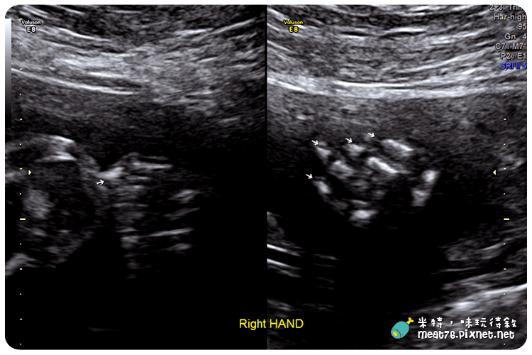 米特，味玩待敘｜部落格 © MEAT76｜台灣美食旅遊部落客｜2014-10-02-4【懷孕產檢紀錄7番外篇】24W+4D｜禾馨婦產科｜高層次超音波檢查 ( 自費3,800元 ) 建議20~24週檢查013.png