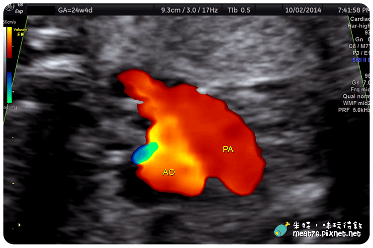 米特，味玩待敘｜部落格 © MEAT76｜台灣美食旅遊部落客｜2014-10-02-4【懷孕產檢紀錄7番外篇】24W+4D｜禾馨婦產科｜高層次超音波檢查 ( 自費3,800元 ) 建議20~24週檢查015.png