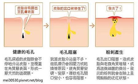 媲美傳統挽臉法寶‧拔粉刺的專家：絲晶煥采緊緻面膜