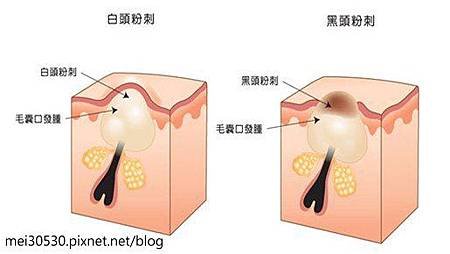 媲美傳統挽臉法寶‧拔粉刺的專家：絲晶煥采緊緻面膜