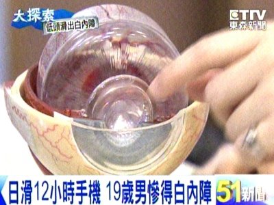 19歲電玩業餘玩家 滑手機12小時患白內障2