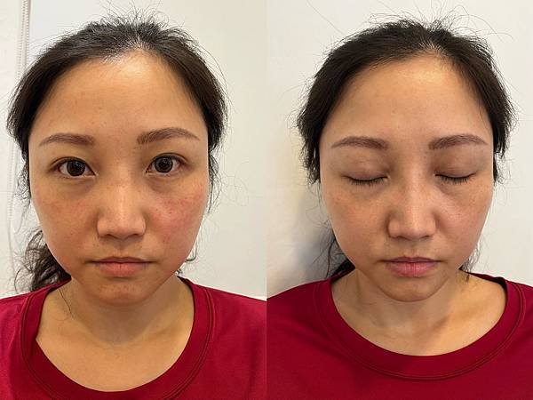 【醫美】台中醫美推薦❞悠美診所 ⓑ 蜂巢皮秒雷射