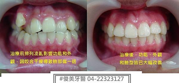 齒顎矯正可以不需拔除小臼齒
