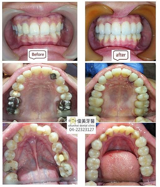 牙齒的治療成效-長效和短效的差異