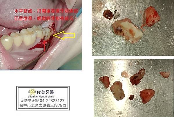 水平、埋伏齒拔除實例78