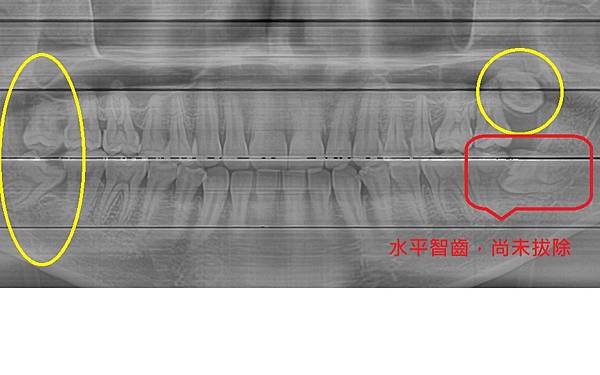 水平、埋伏齒拔除實例78