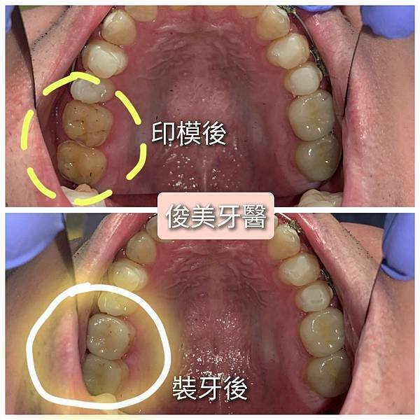 榫接式人工牙冠27