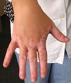 250px-Vitiligo03.jpg