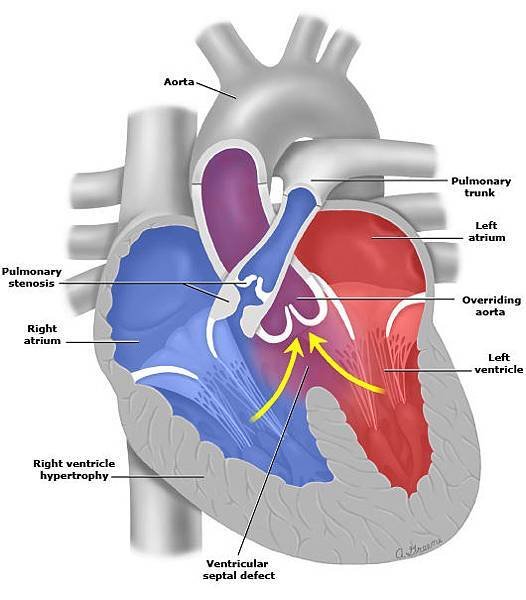 Anatomy of tetralogy_of_Fal