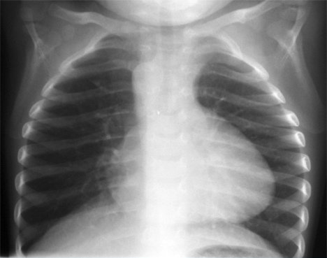 Chest_xray_tetralogy_Fallot