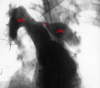 Tetralogy_Fallot_PA_angio_I