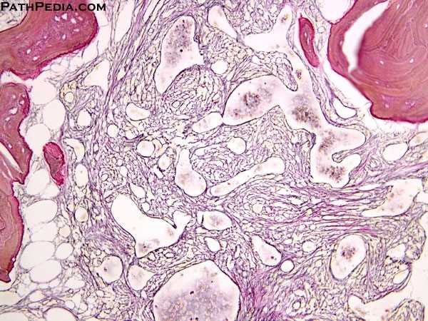 primary-(idiopathic)-myelofibrosis_-[10-bm102