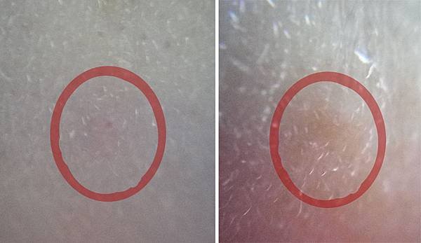 皮質管絲毛孔.jpg