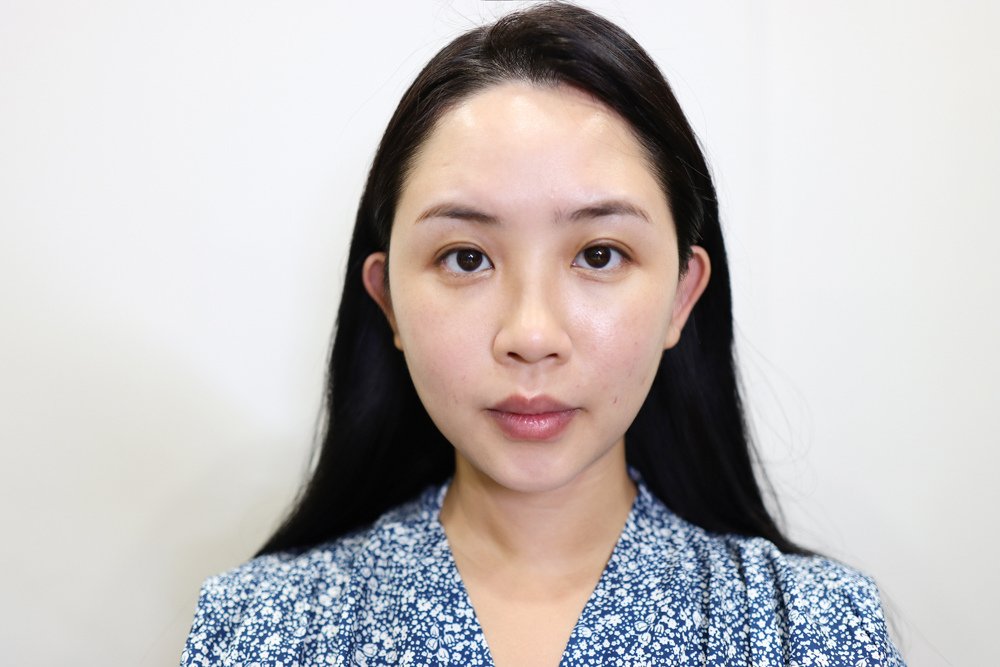 〖醫美紀錄〗雀斑byebye！臉變得更白淨了 美美上美 4D