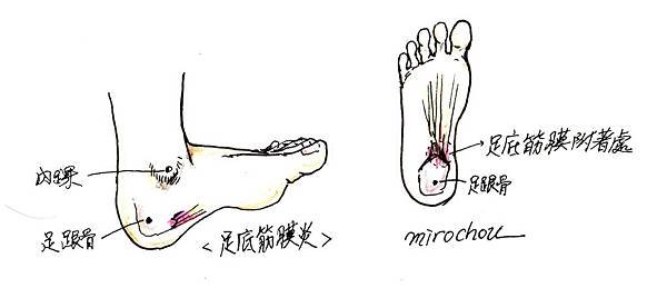 足底筋膜炎