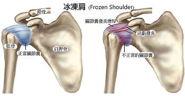 FrozenShoulder_SM.jpg