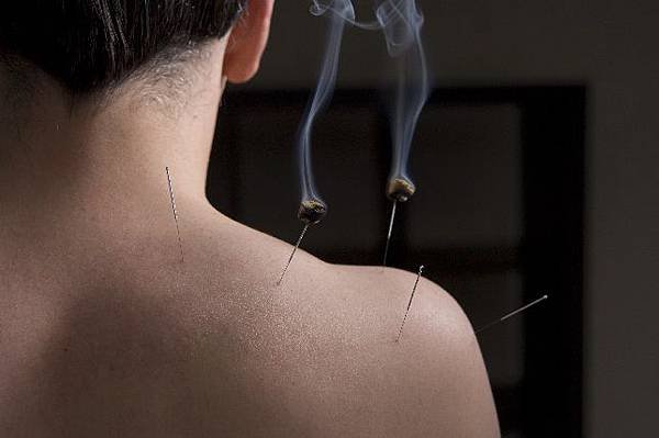 Frozen-Shoulder-being-treated-with-Acupuncture.jpg