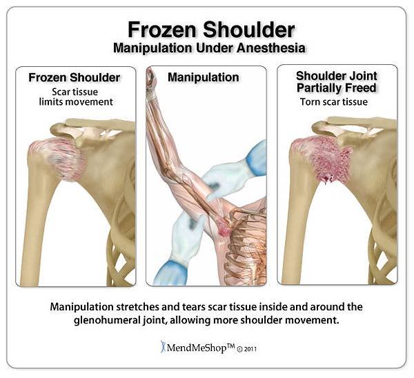 frozen-shoulder-manipulation.jpg