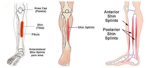 Shin-Splints-1.jpg